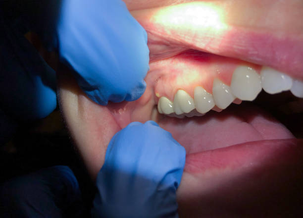 Best Emergency Care for Gum Disease in Culloden, WV